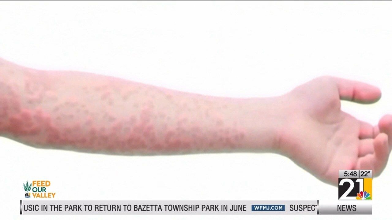 Measles cases & exposure on the rise